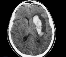 Внутримозговые опухоли полушарий мозга фото 1