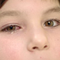 Аллергический конъюнктивит у детей фото 3