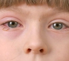 Аллергический конъюнктивит у детей фото 1