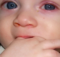 Аллергический конъюнктивит у детей фото 0