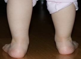 Вальгусная деформация стопы у детей фото 1