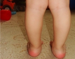 Вальгусная деформация стопы у детей фото 3