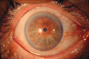 Глаукома фото 3