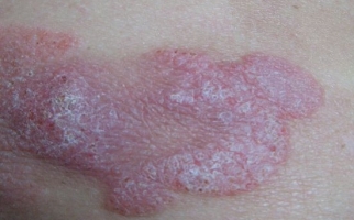 Лимфома кожи
