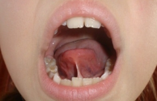 Короткая уздечка языка у ребенка фото 2