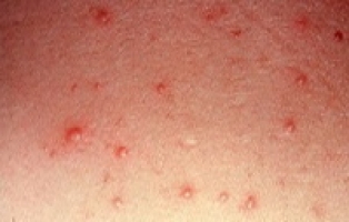 Буллезный дерматит фото 1