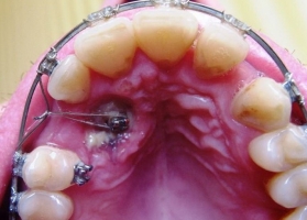 Ретинированный зуб фото 1