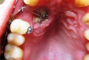 Ретинированный зуб фото 2