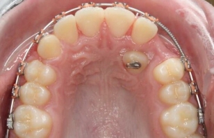 Ретинированный зуб фото 0
