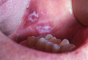 Лейкоплакия полости рта фото 2