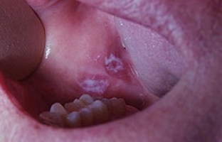 Лейкоплакия полости рта фото 0