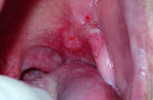 Лейкоплакия полости рта фото 1