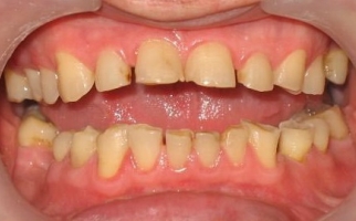Патологическая стираемость зубов
