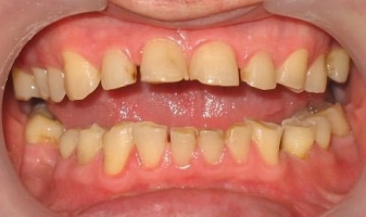 Патологическая стираемость зубов фото 0