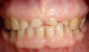 Патологическая стираемость зубов фото 1