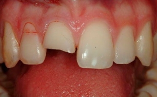 Перелом зуба