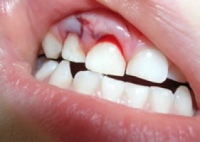 Вывих зуба фото 1