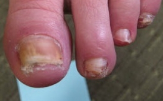 Эпидермофития ногтей (ЭН)