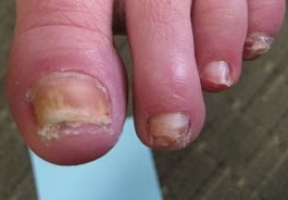 Эпидермофития ногтей (ЭН) фото 0
