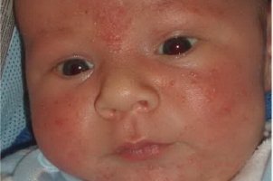 Эпидемическая пузырчатка новорожденных (ЭПН) фото 2