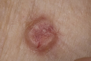 Рак кожи (РК) фото 2
