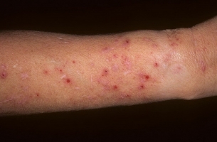 Транзиторный акантолитический дерматоз Гровера — Википедия