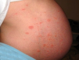 Аллергия при беременности фото 3
