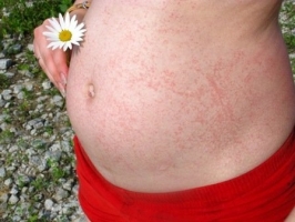 Аллергия при беременности фото 2