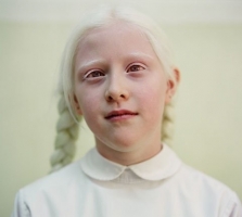 Альбинизм фото 1