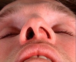 Искривление перегородки носа фото 4