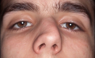 Искривление перегородки носа фото 2
