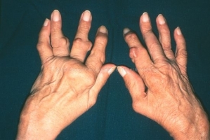 Ревматоидный полиартрит