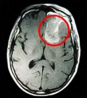Рак головного мозга фото 0