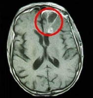 Рак головного мозга фото 1