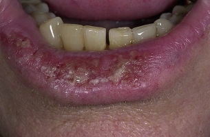 Рак губы  фото 3