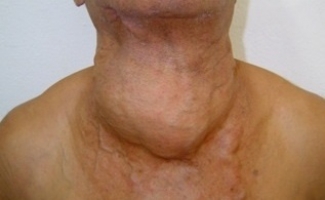 Рак щитовидной железы фото 1