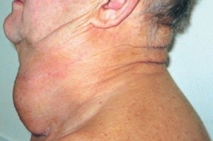 Рак щитовидной железы фото 2
