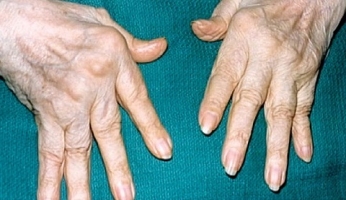 Ревматоидный артрит фото 3