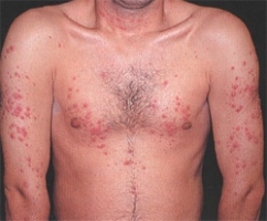 Лекарственная аллергия фото 1