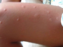 Инсектная аллергия фото 2
