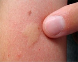 Инсектная аллергия фото 1