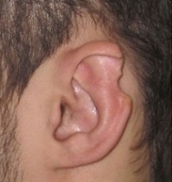 Деформация ушных раковин фото 0