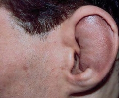 Деформация ушных раковин фото 2