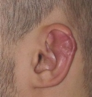 Деформация ушных раковин фото 1