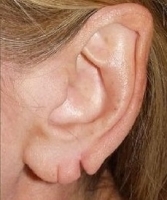 Деформация ушных раковин фото 5