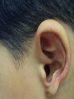 Деформация ушных раковин фото 4