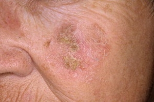 Заболевания кожи фото 1