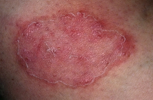 Заболевания кожи фото 3