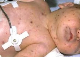 Цитомегаловирусная инфекция фото 2