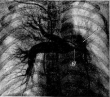 Тромбоэмболия легочной артерии (ТЭЛА) фото 1